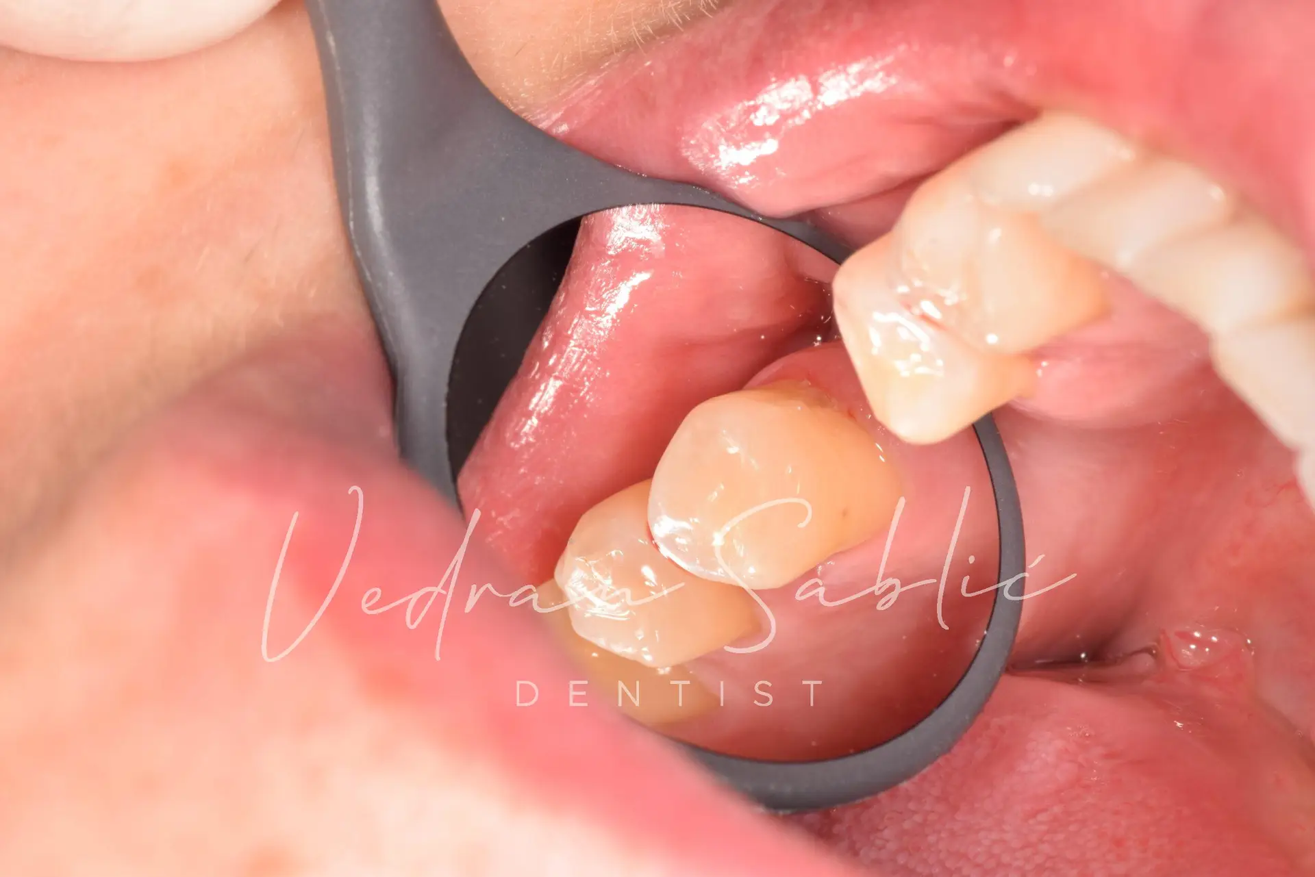 TOP_dent_Plomba10