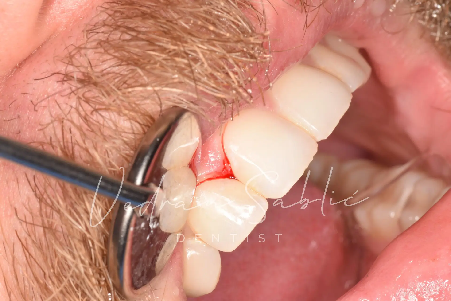 TOP_dent_Plomba13