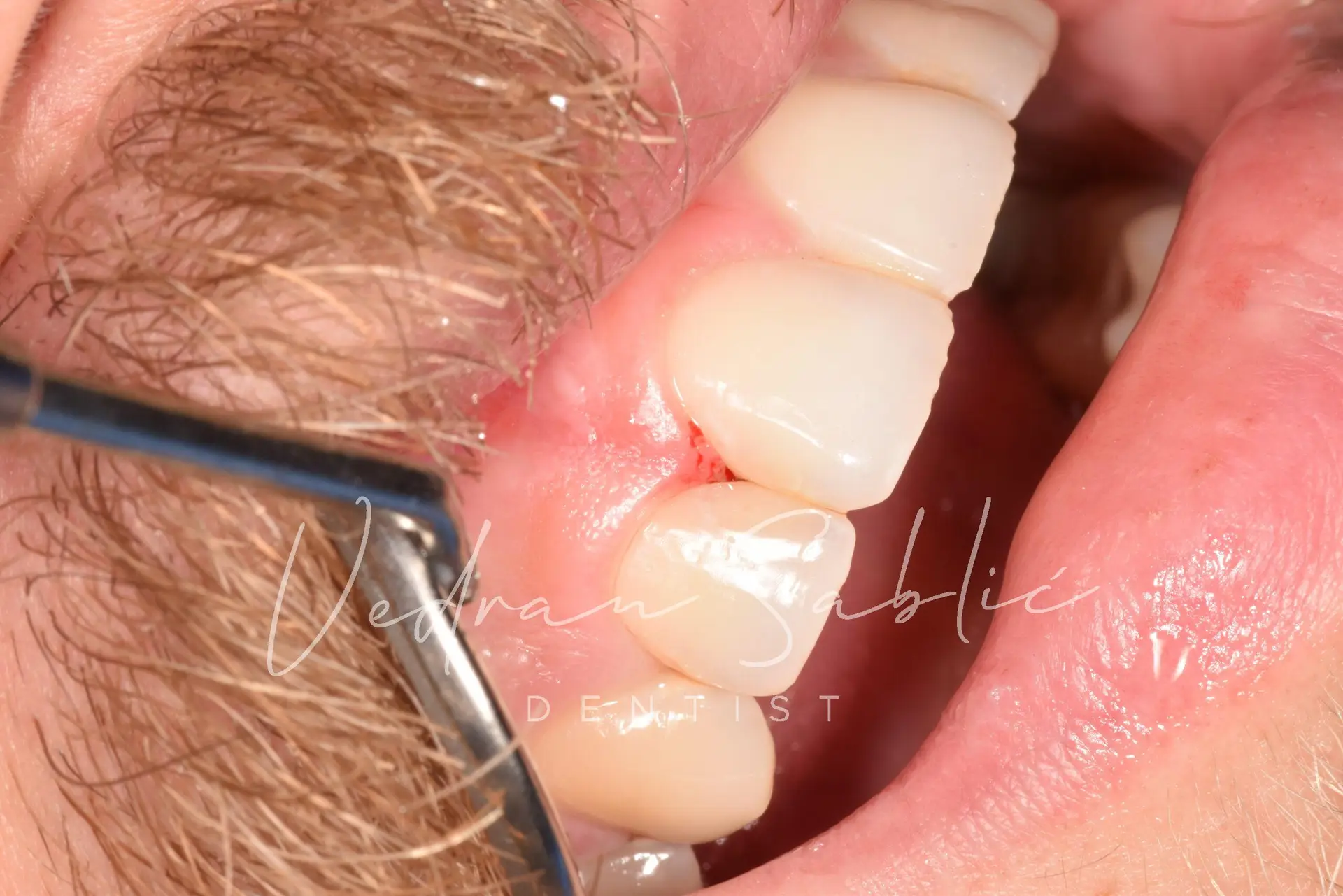 TOP_dent_Plomba15
