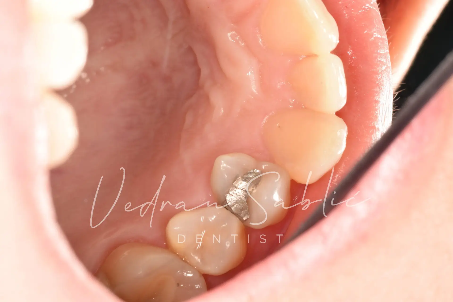 TOP_dent_Plomba26