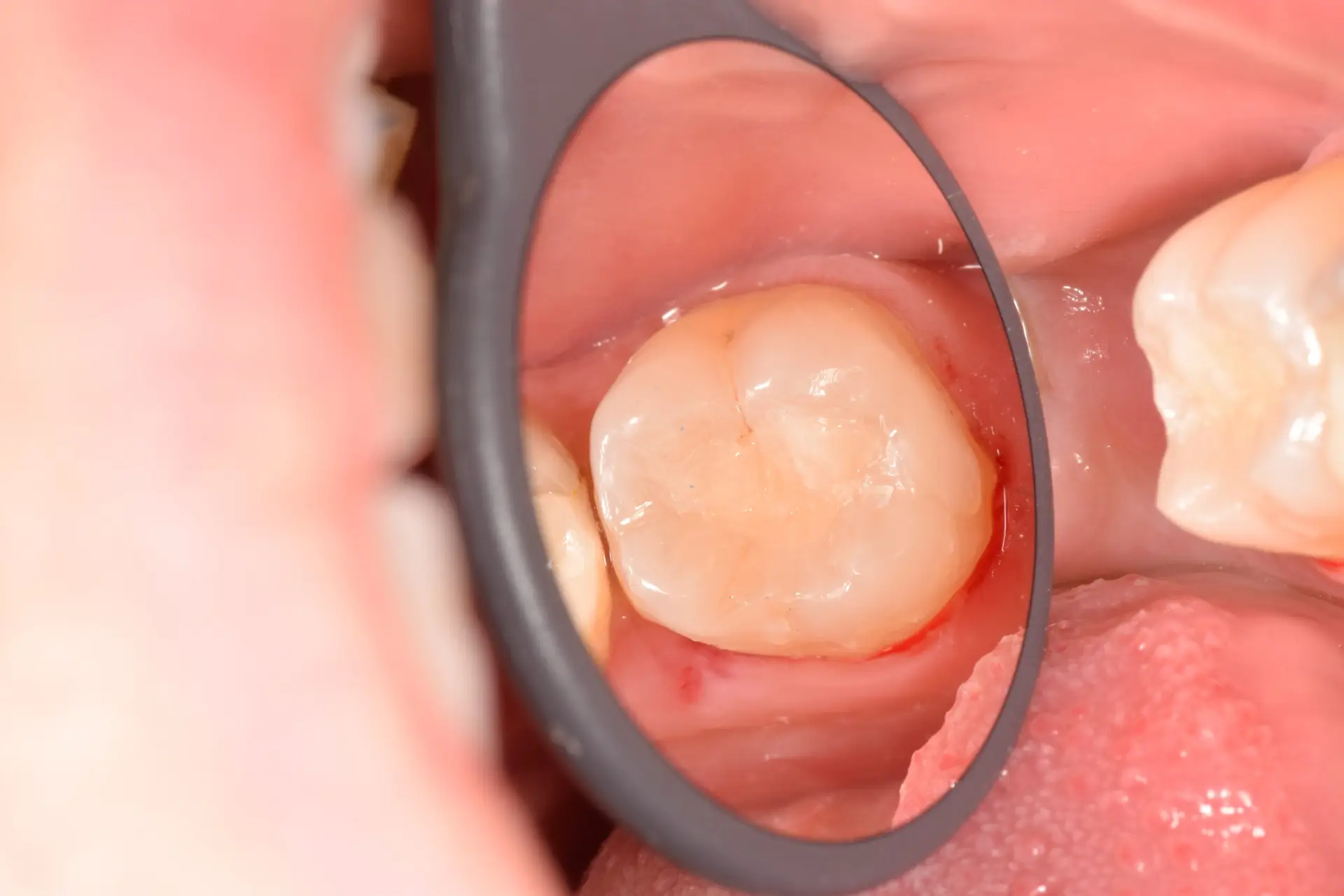 TOP_dent_Plomba3