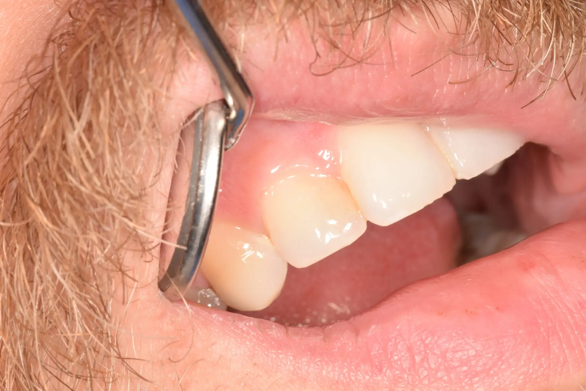 TOP_dent_Plomba12
