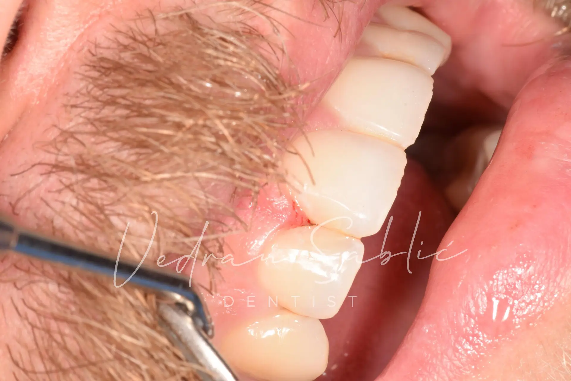 TOP_dent_Plomba14
