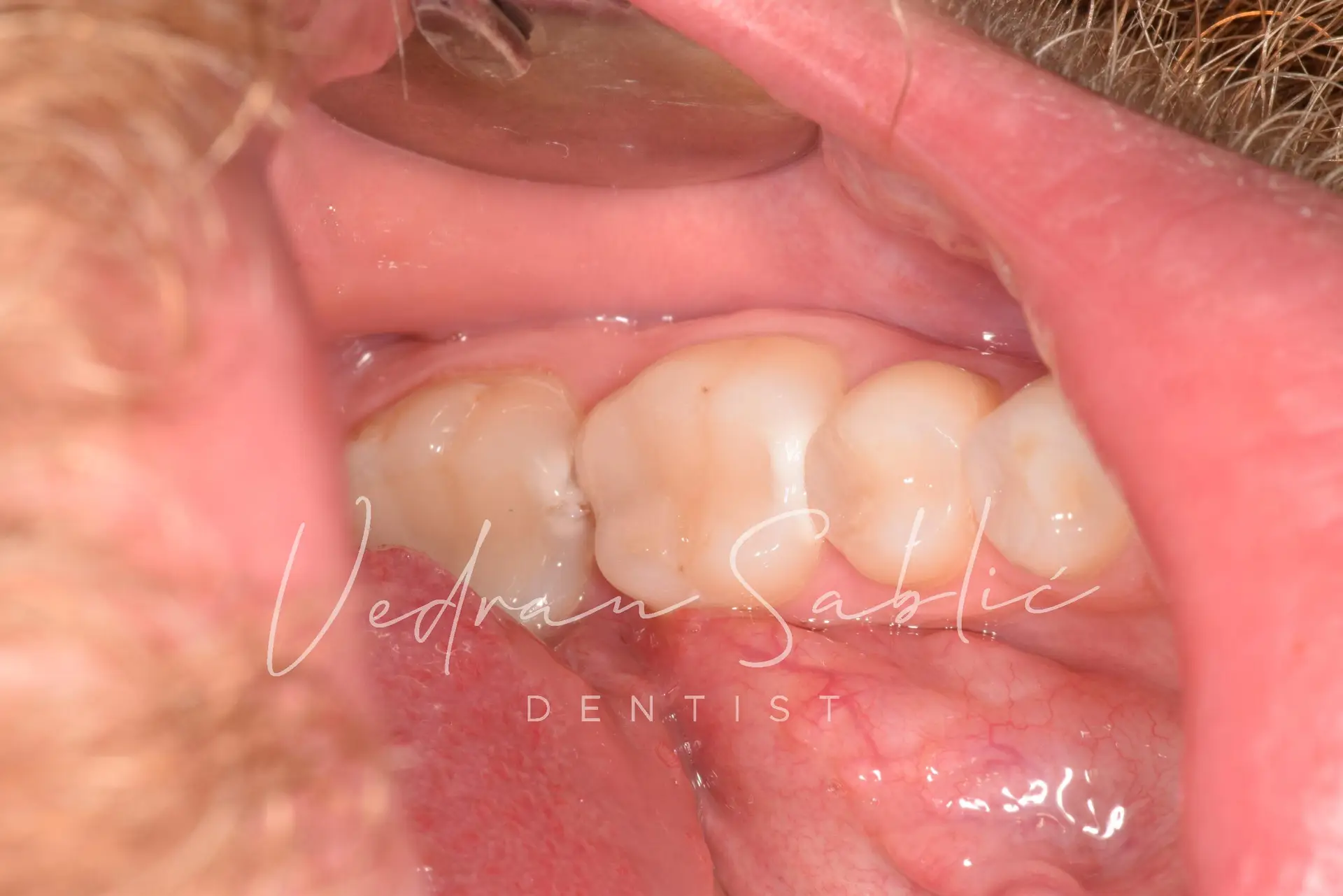 TOP_dent_Plomba16