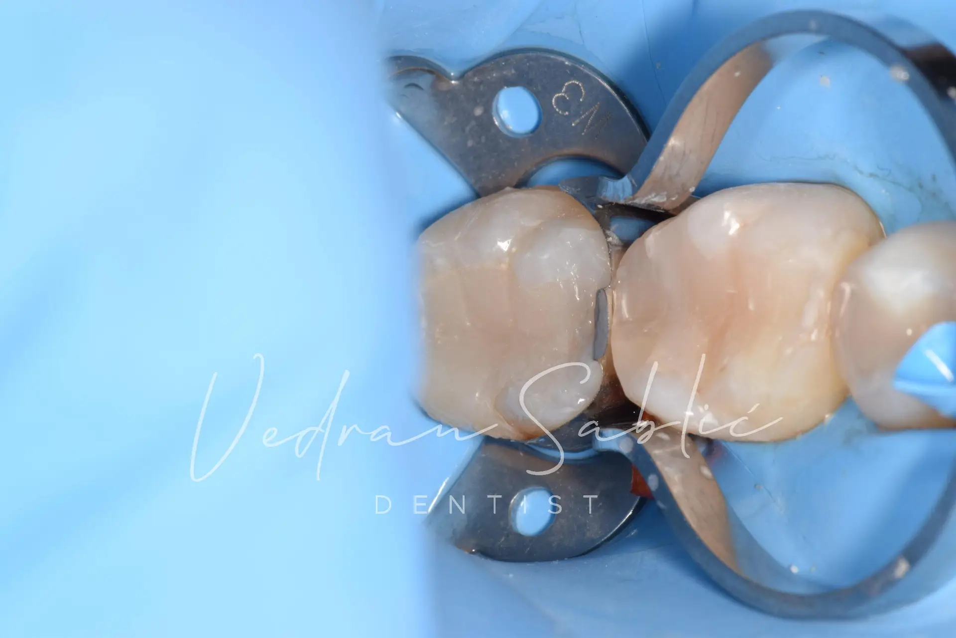 TOP_dent_Plomba20