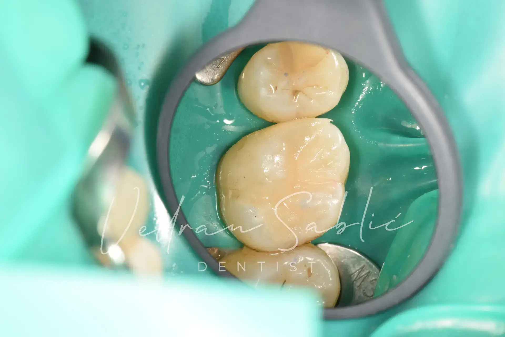 TOP_dent_Plomba7